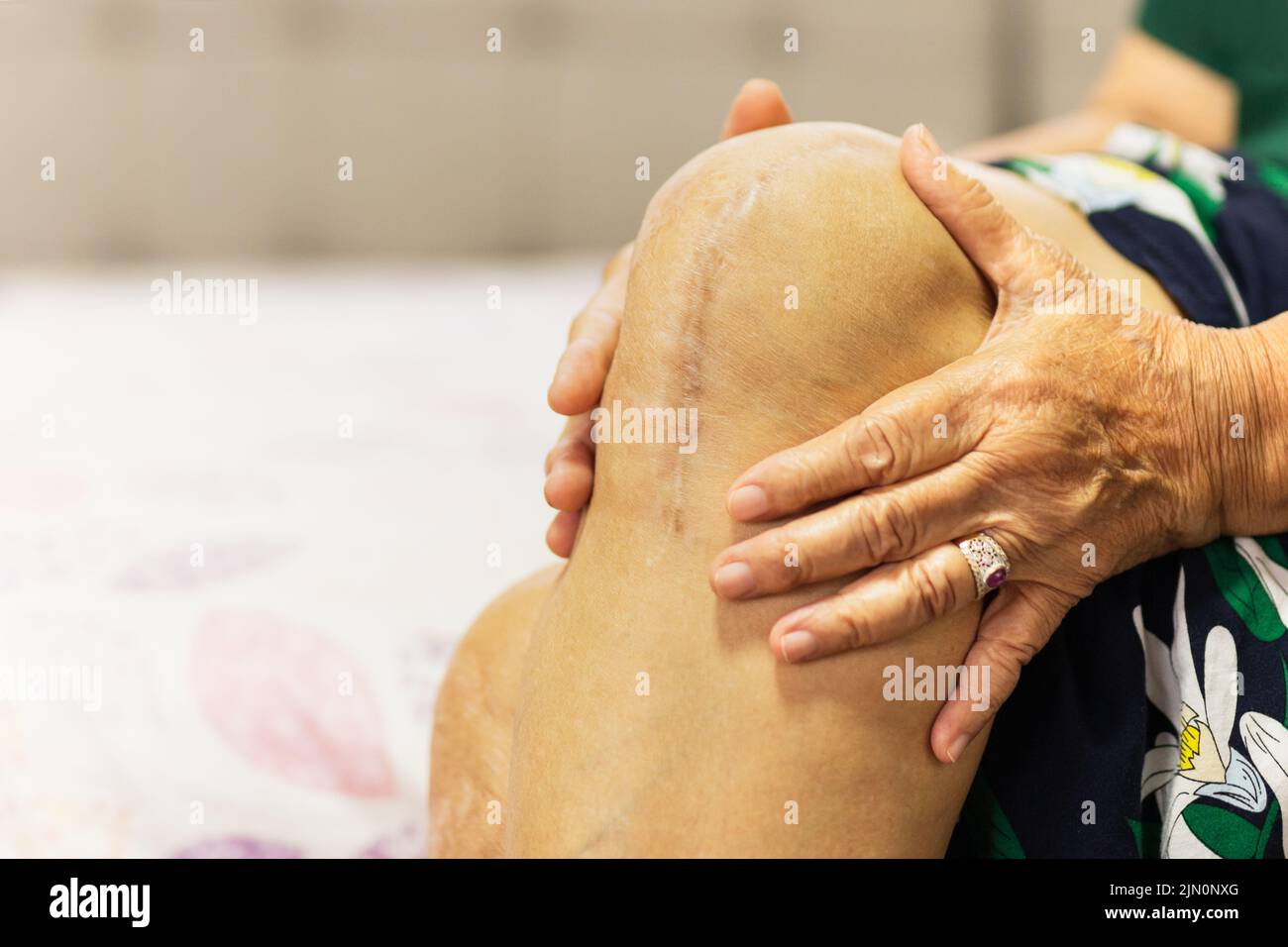 Elderly woman show her scar knee replacement surgery. Stock Photo