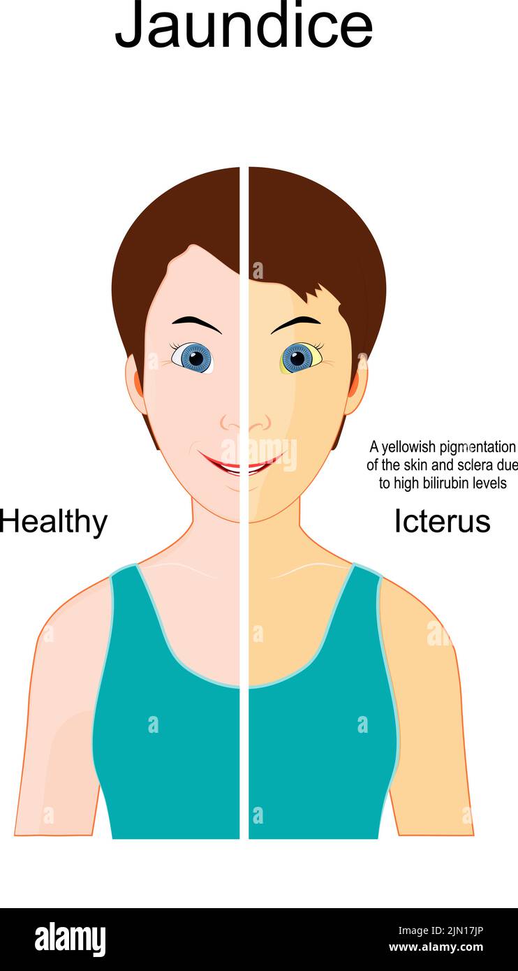 Jaundice. The Comparison between Healthy person and person with Icterus. yellowish pigmentation of the skin and sclera due to high bilirubin levels. Stock Vector
