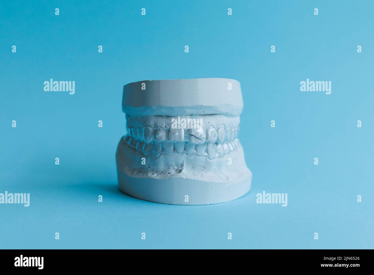 Dental plaster model of human jaw before treatment with braces Stock