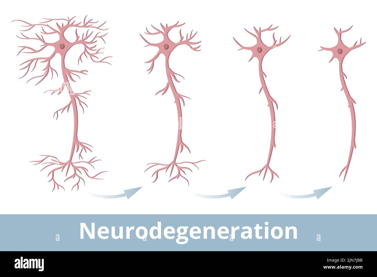 Neurodegeneration. Degeneration of a nerve cell, that occurs because of multiple sclerosis, Parkinson's disease, Alzheimer's disease Stock Vector
