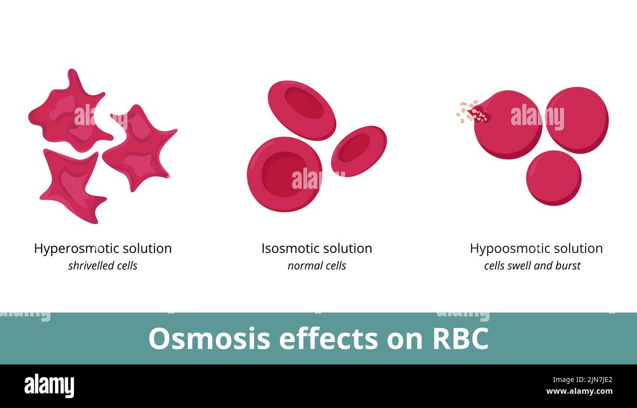 Osmosis effect on red blood cells. Depending on solution concentration (hyperosmotic, isosmotic, or hypoosmotic), erythrocytes can shrivel or swell Stock Vector