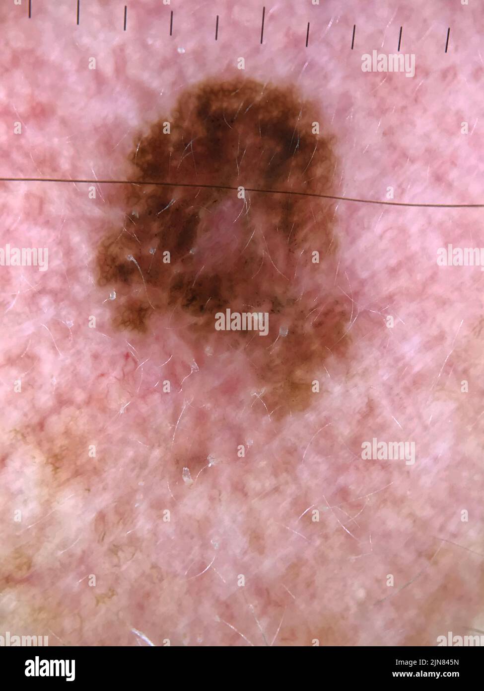 Melanoma in situ, dermoscopy Stock Photo Alamy