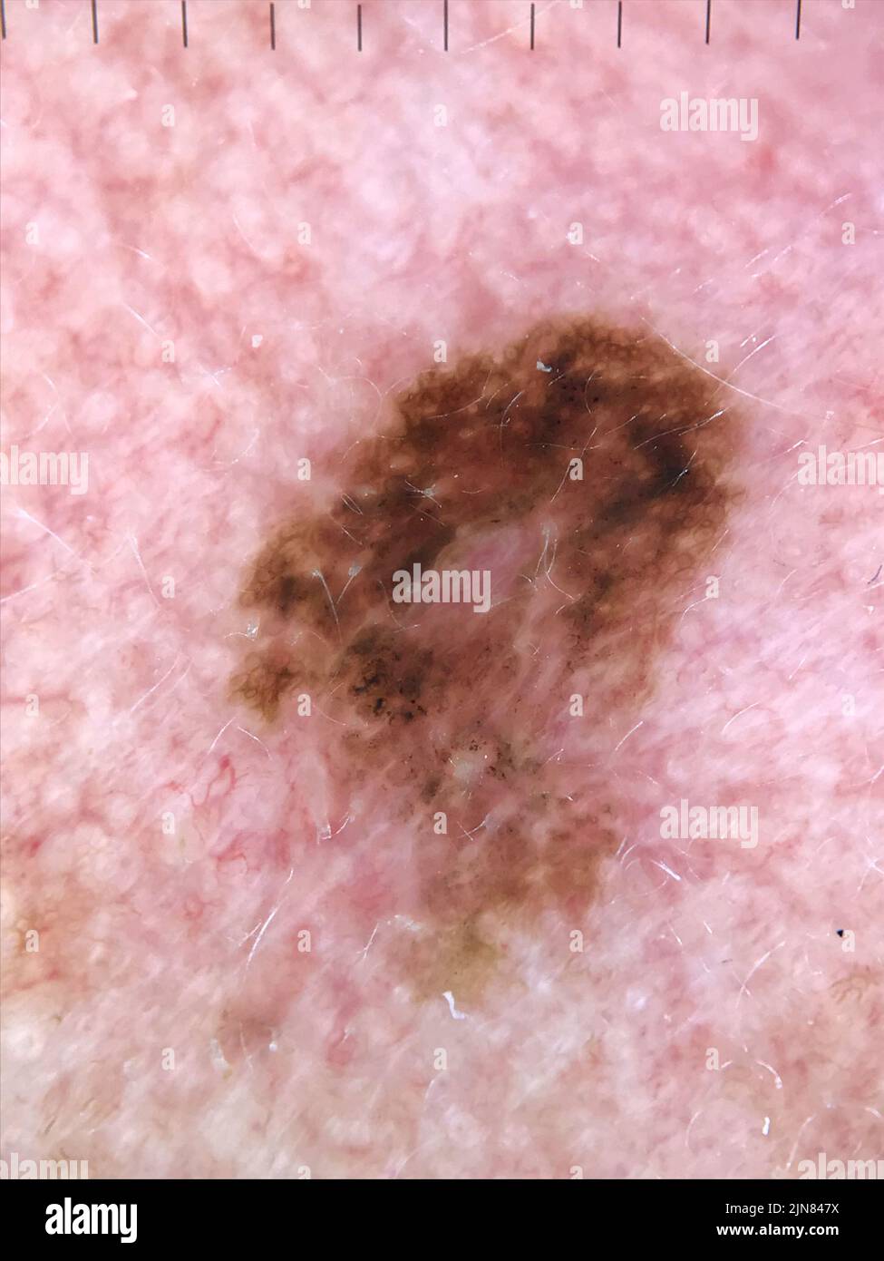 Melanoma in situ, dermoscopy Stock Photo Alamy