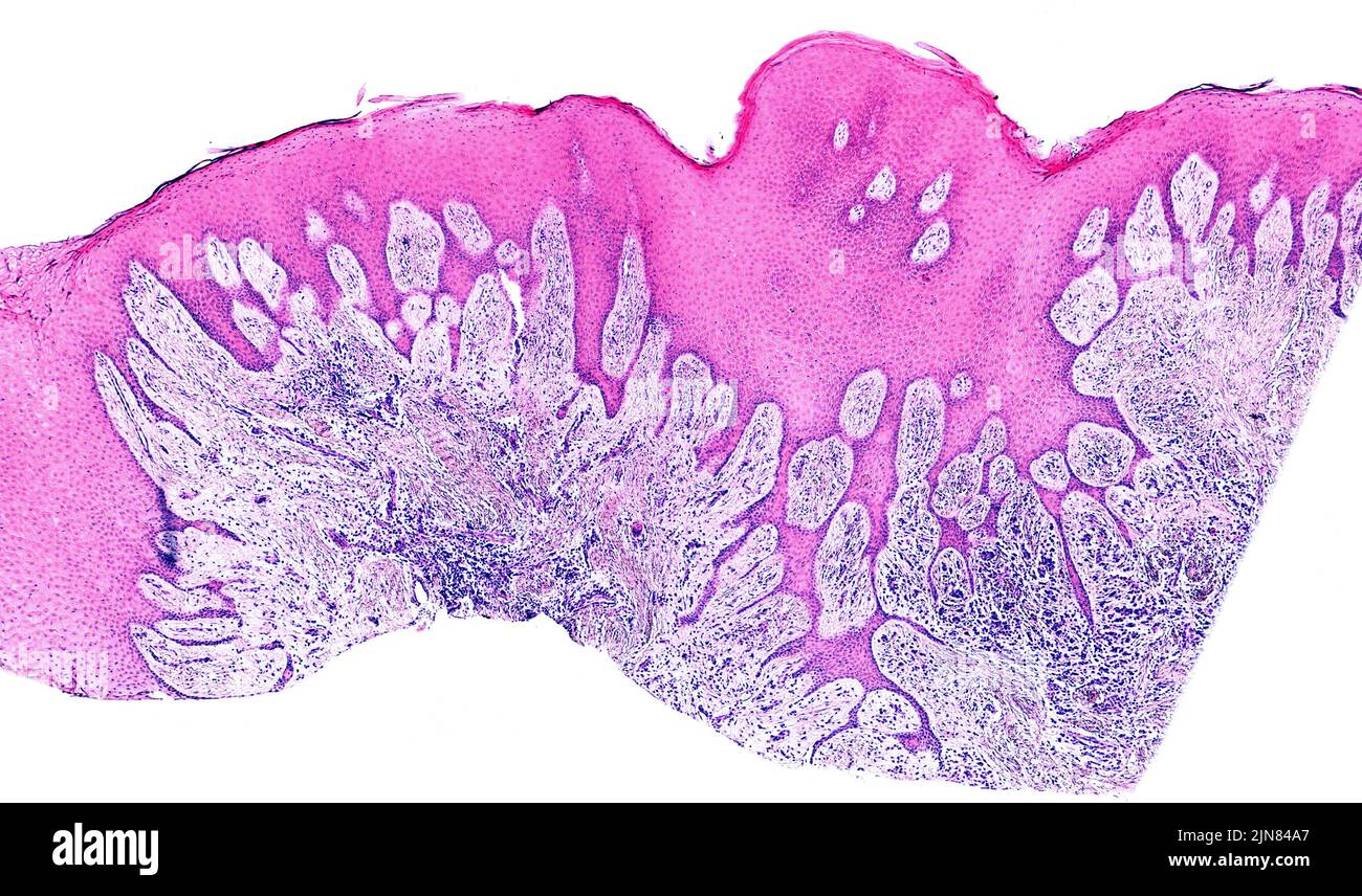 Gingivitis, light micrograph Stock Photo Alamy