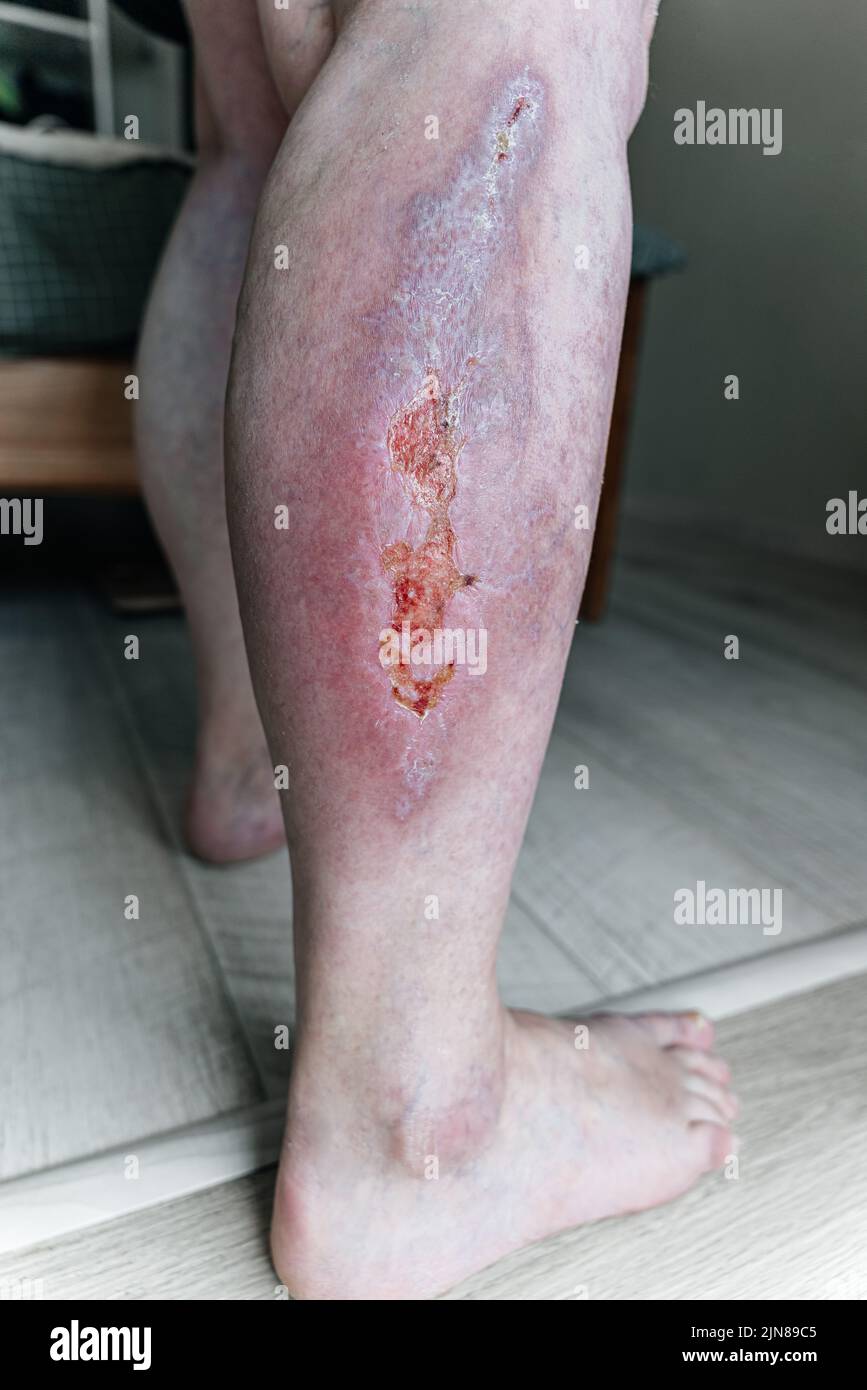 Scars on leg hi-res stock photography and images - Alamy