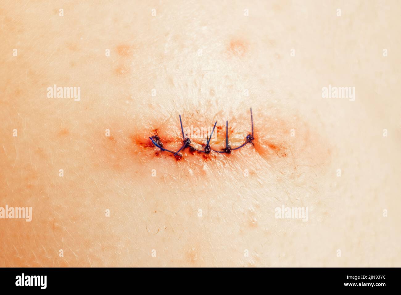 Medical stitches hi-res stock photography and images - Alamy