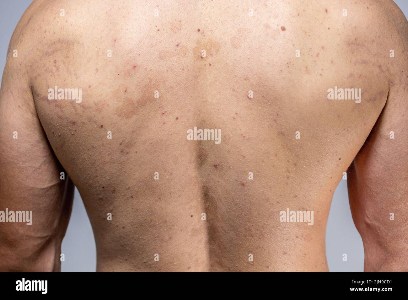 tinea versicolor on the back. pityriasis versicolor problem with