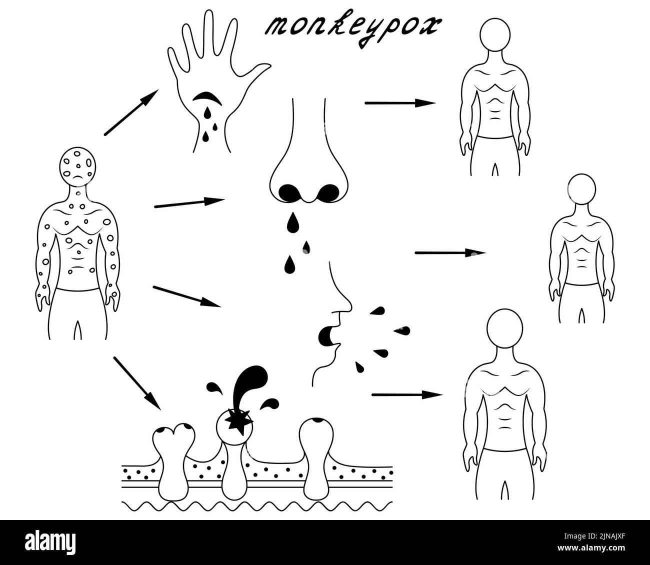 Methods of human infection with monkeypox. Diagram of human-to-human transmission of smallpox. Sketch. In contact with body fluids, damaged skin Stock Vector