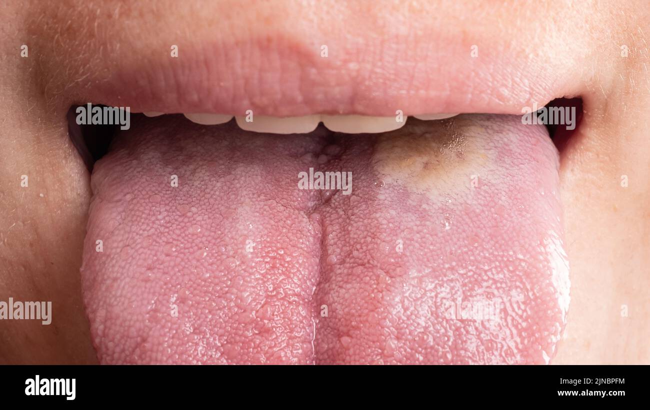 stomatitis inflammation of the tongue, cancer of the tongue closeup Stock Photo