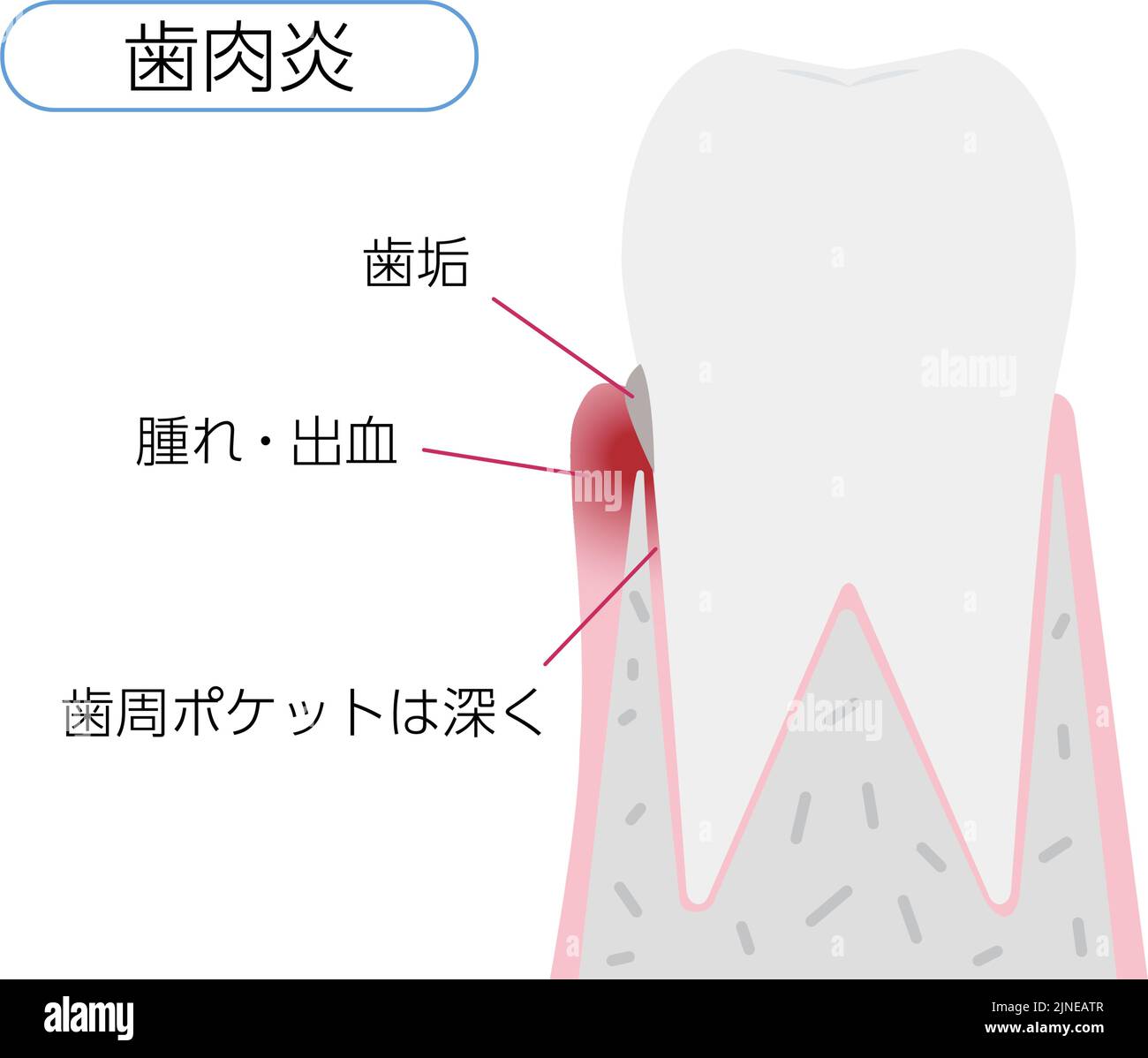 Illustration by stage of periodontal disease Gingivitis Translation