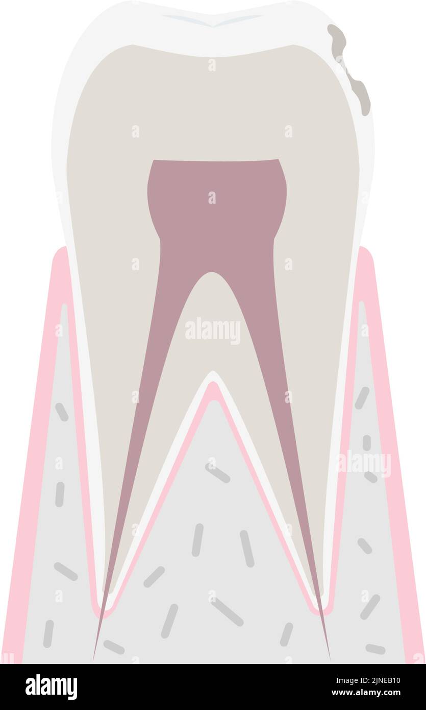 Progress of tooth decay, tooth surface begins to melt Stock Vector
