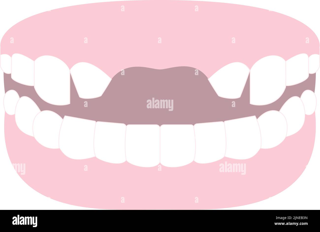 Illustration of tooth sharpened to bridge anterior teeth Stock Vector