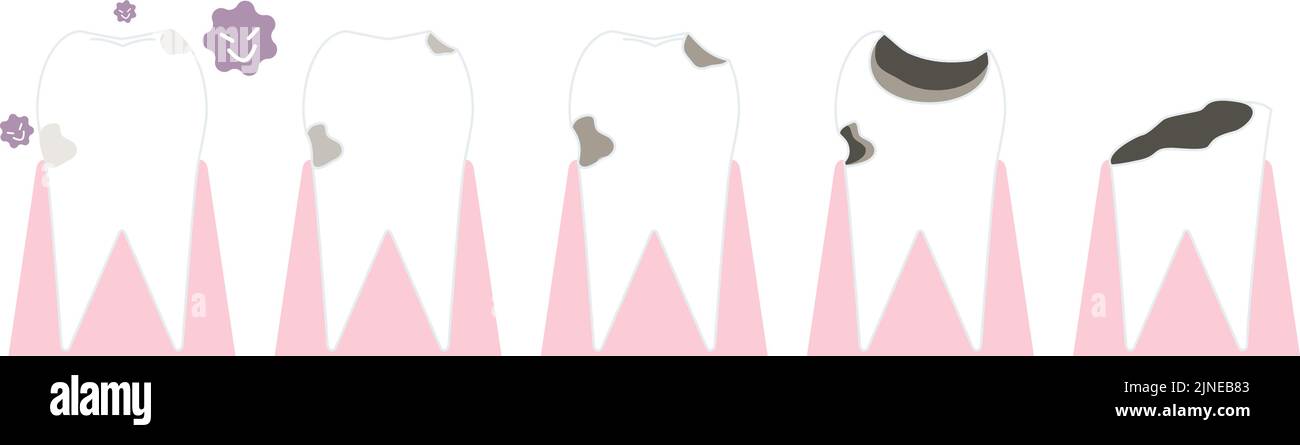 Illustration of progress of tooth decay Stock Vector Image & Art - Alamy