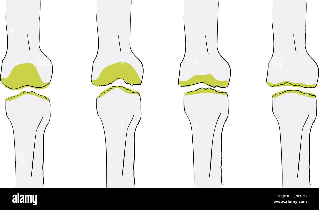 Vector illustration of the flow of osteoarthritis of the knee is worse ...