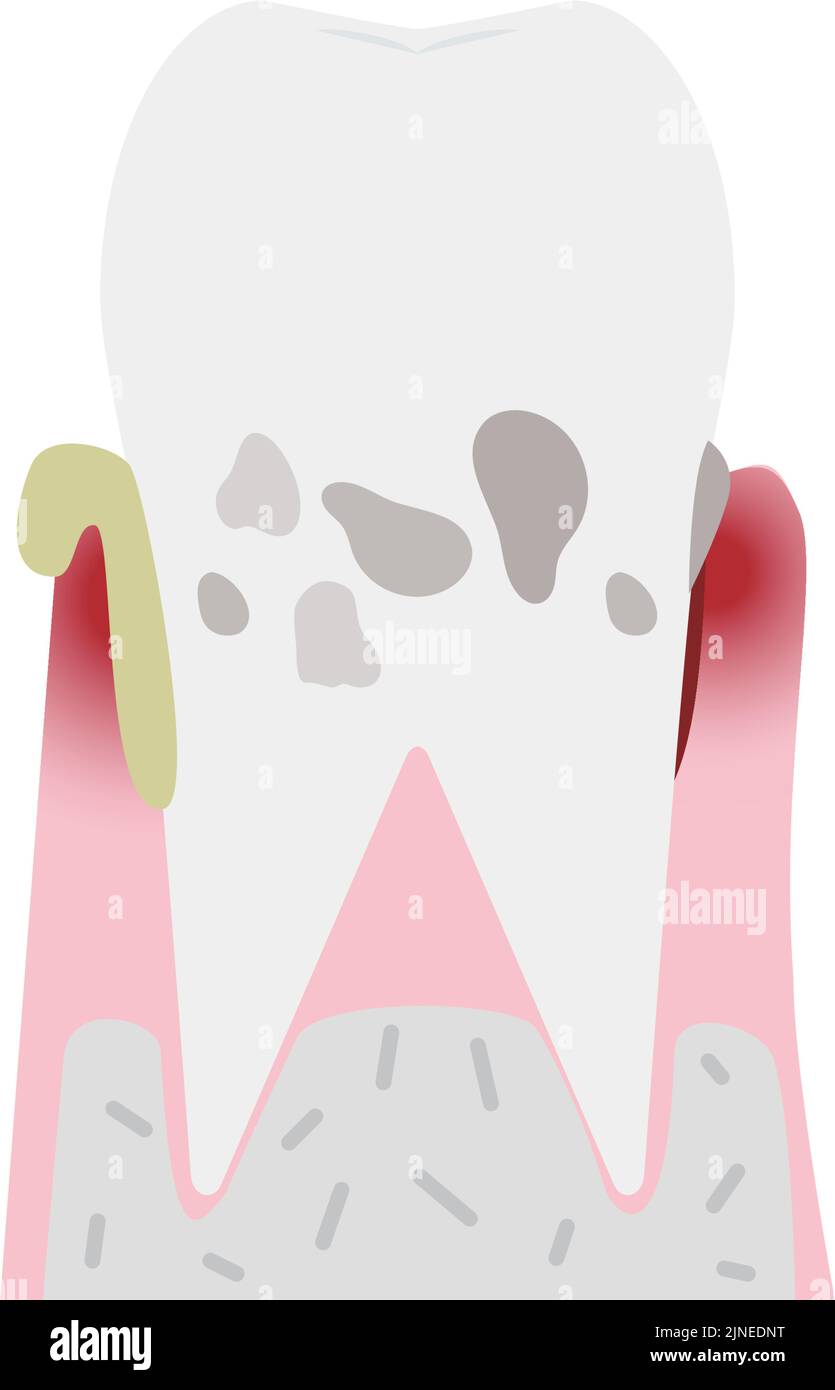 Illustration by stage of periodontal disease: severe periodontitis Stock Vector