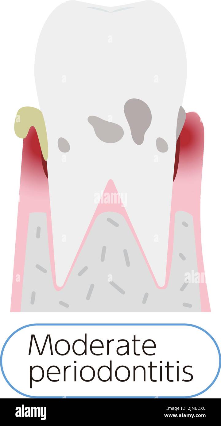 Illustration by stage of periodontal disease: moderate periodontitis Stock Vector