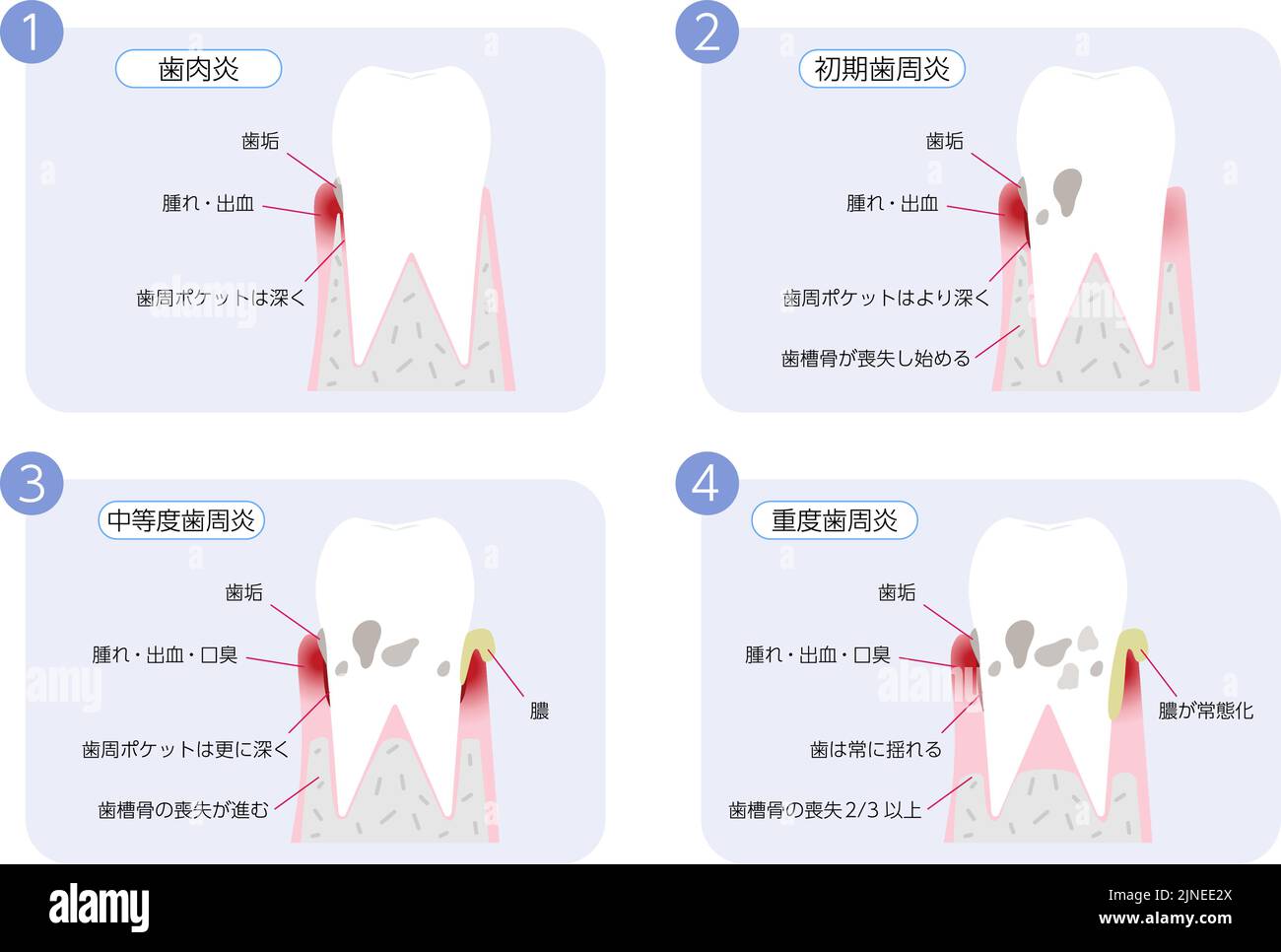 Periodontal disease progression illustration, 4 stages Translation: Gingivitis, early periodontitis, moderate periodontitis, severe periodontitis Stock Vector