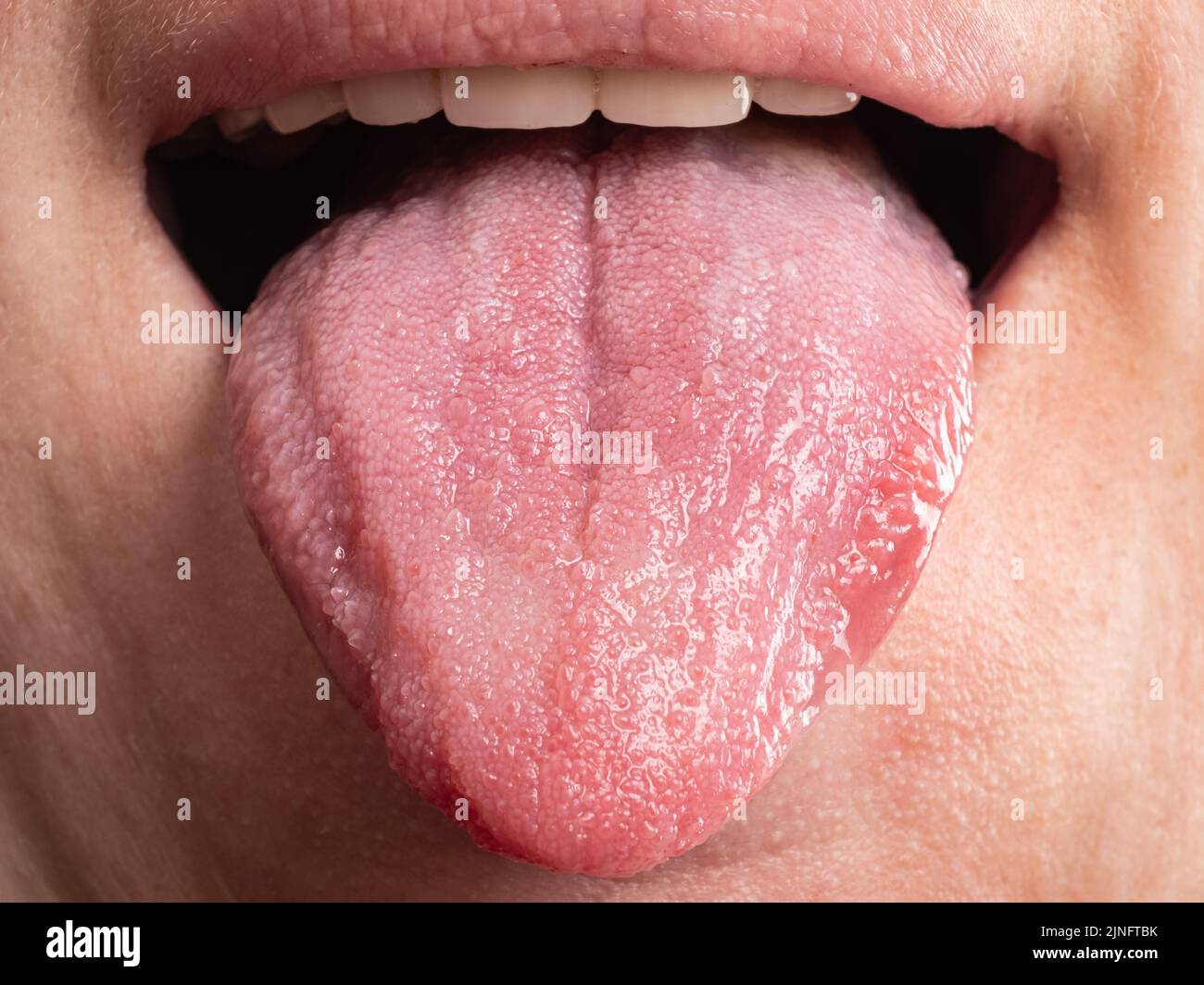diseases of the oral cavity, tongue infections cancer. Stock Photo