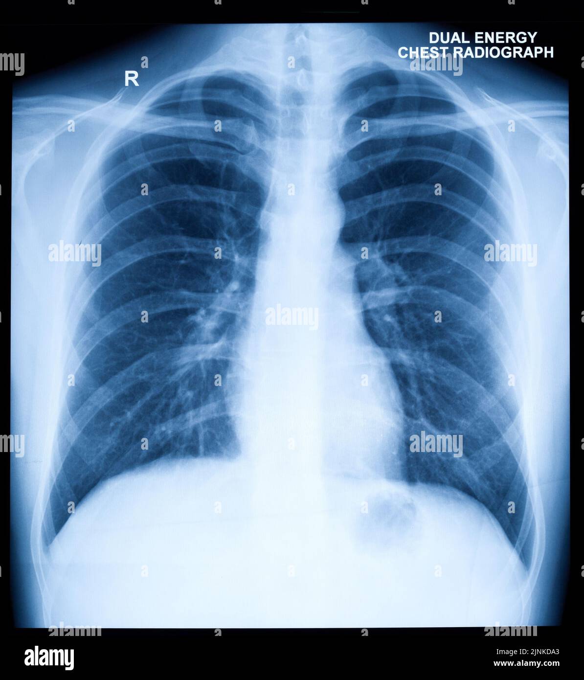 xray image, lung, chest, radiology, xrays, xray, xrays, lungs, chests