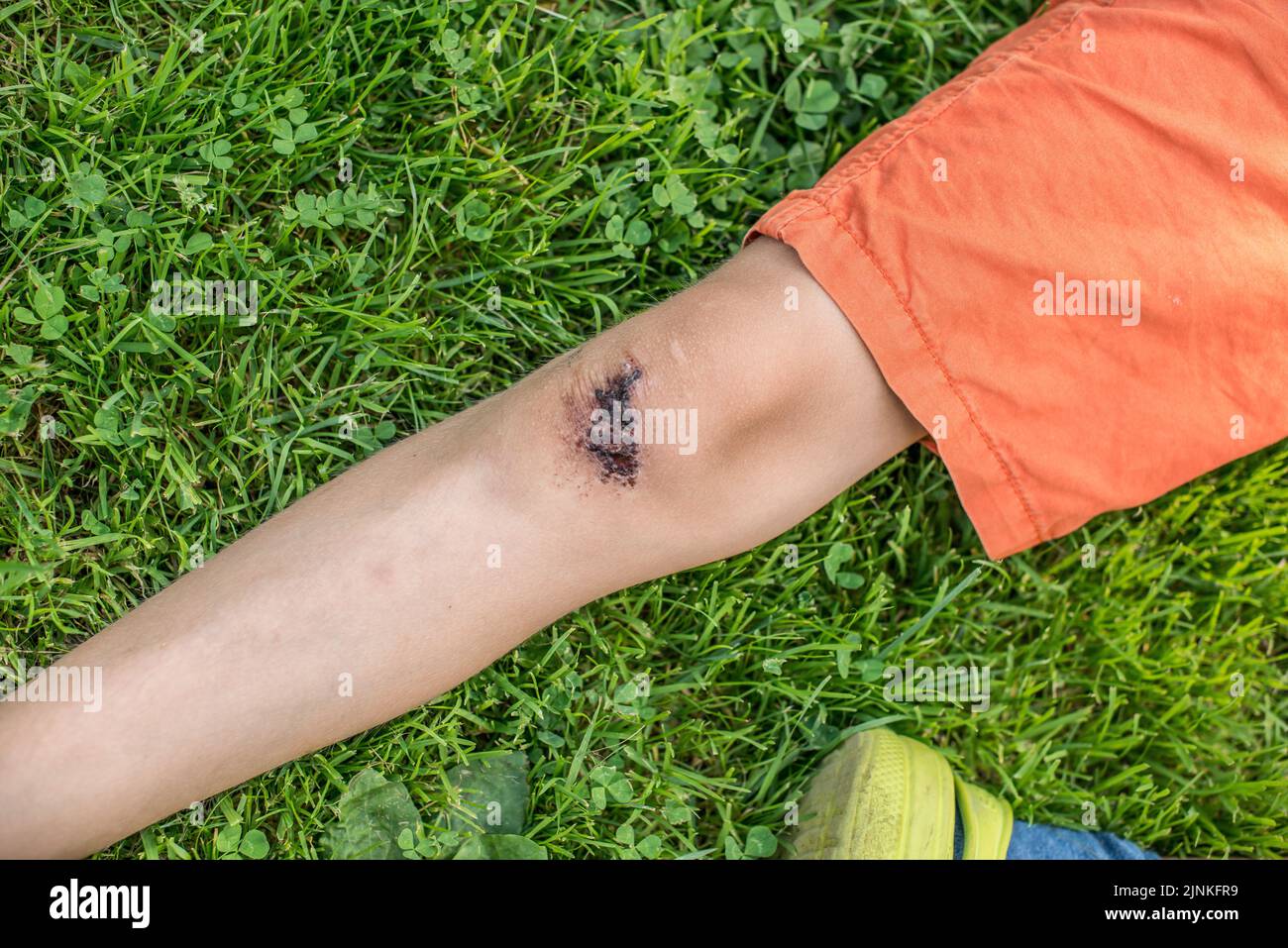 A top view of a leg with a scraped wounded knee on a field Stock Photo