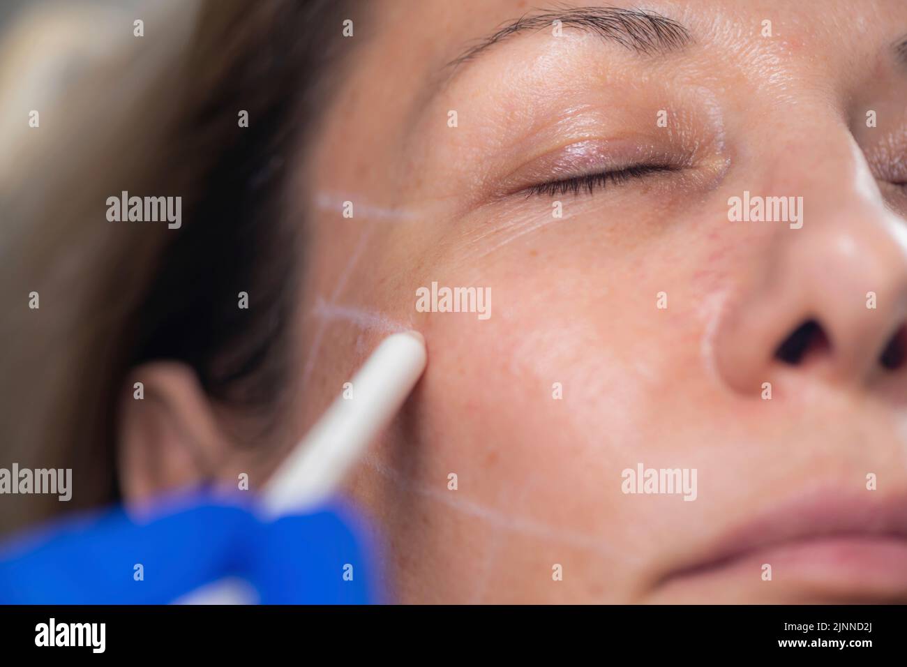 Mesotherapy thread face lift procedure Stock Photo