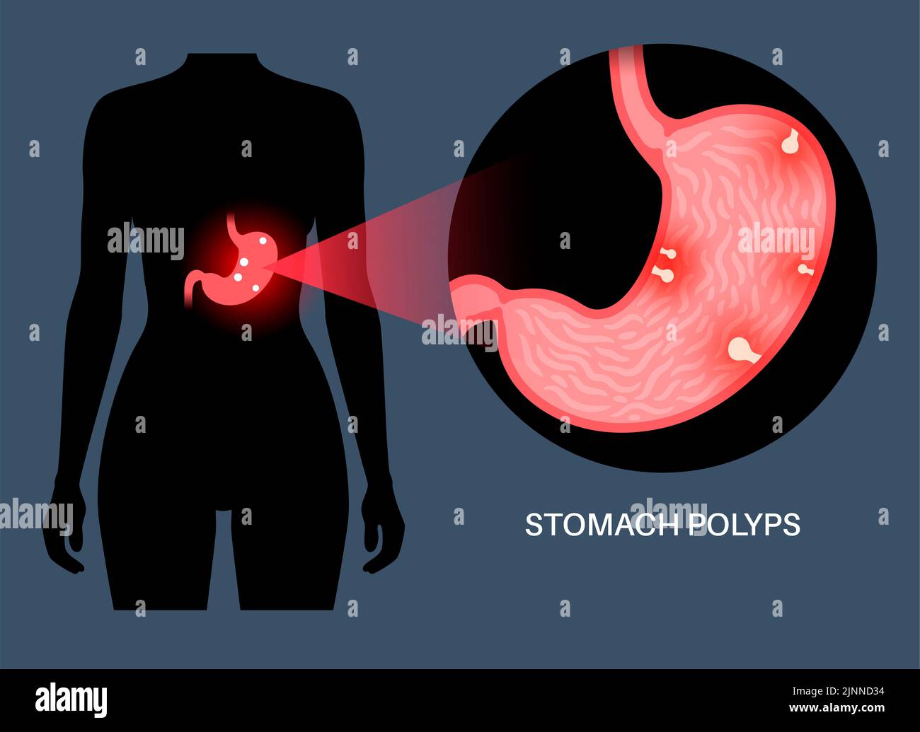 Stomach polyps, illustration Stock Photo