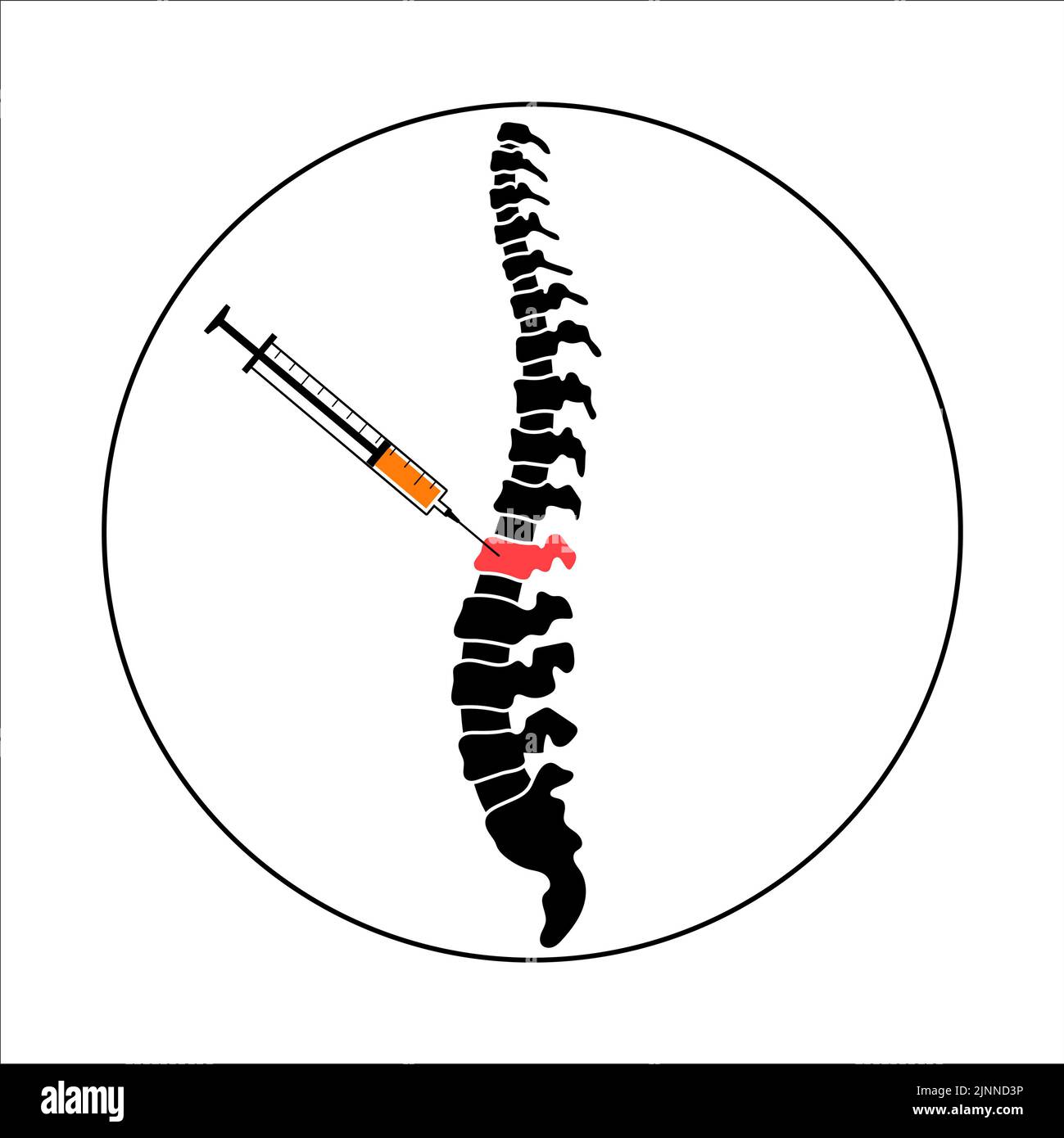 Spinal injection, illustration Stock Photo Alamy