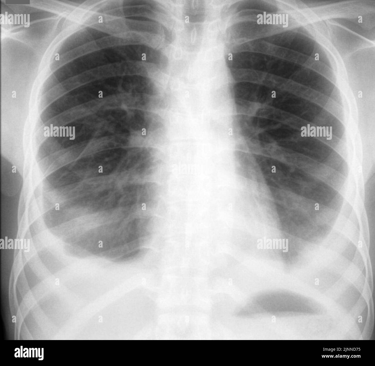X Ray Pleural Effusion Pleural Effusion Definition ZXZMJS