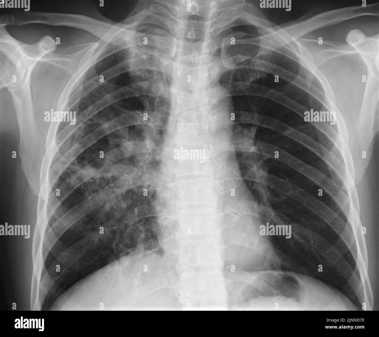 Lung abscess, Xray Stock Photo Alamy