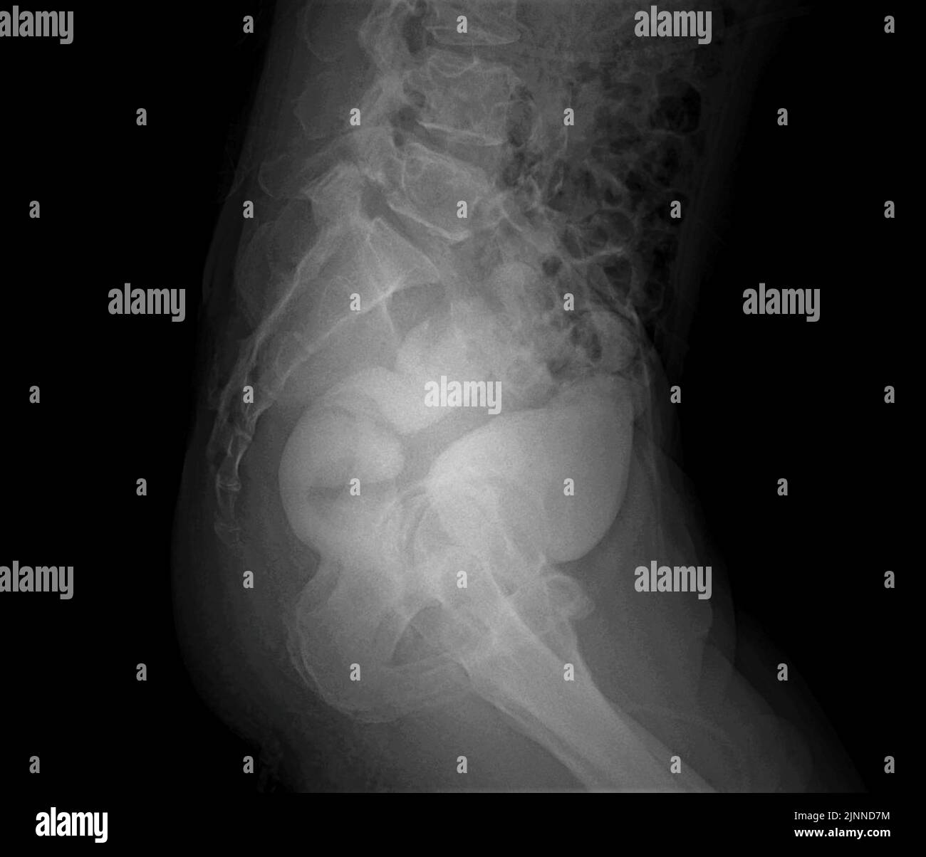 Rectovesical fistula, Xray Stock Photo Alamy