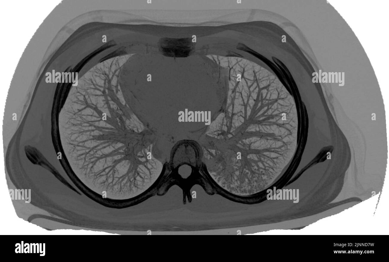 Normal lung, CT scan Stock Photo