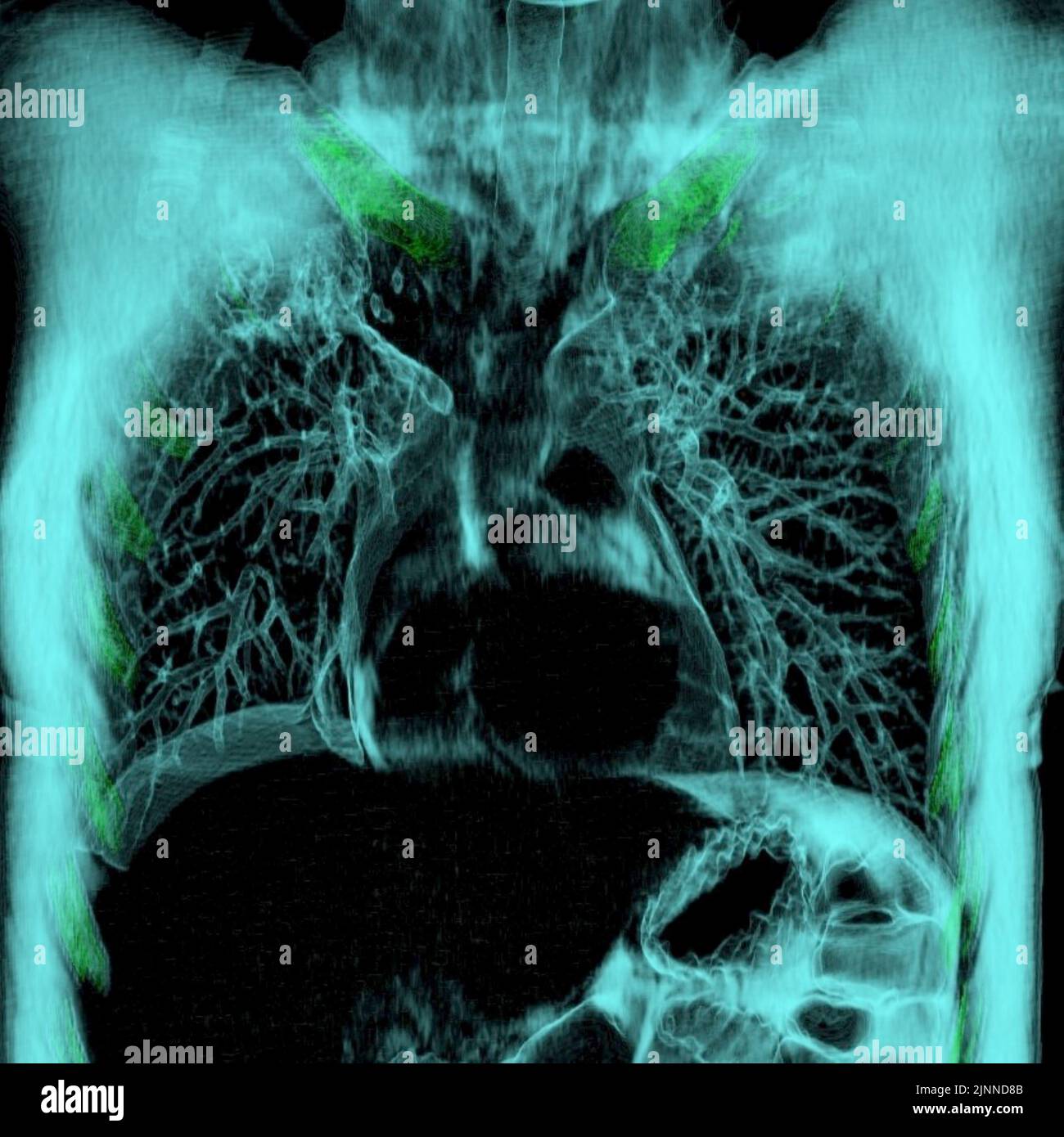 Healthy lungs and heart, CT scan Stock Photo