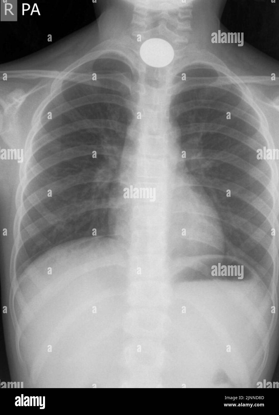 Swallowed coin, Xray Stock Photo Alamy