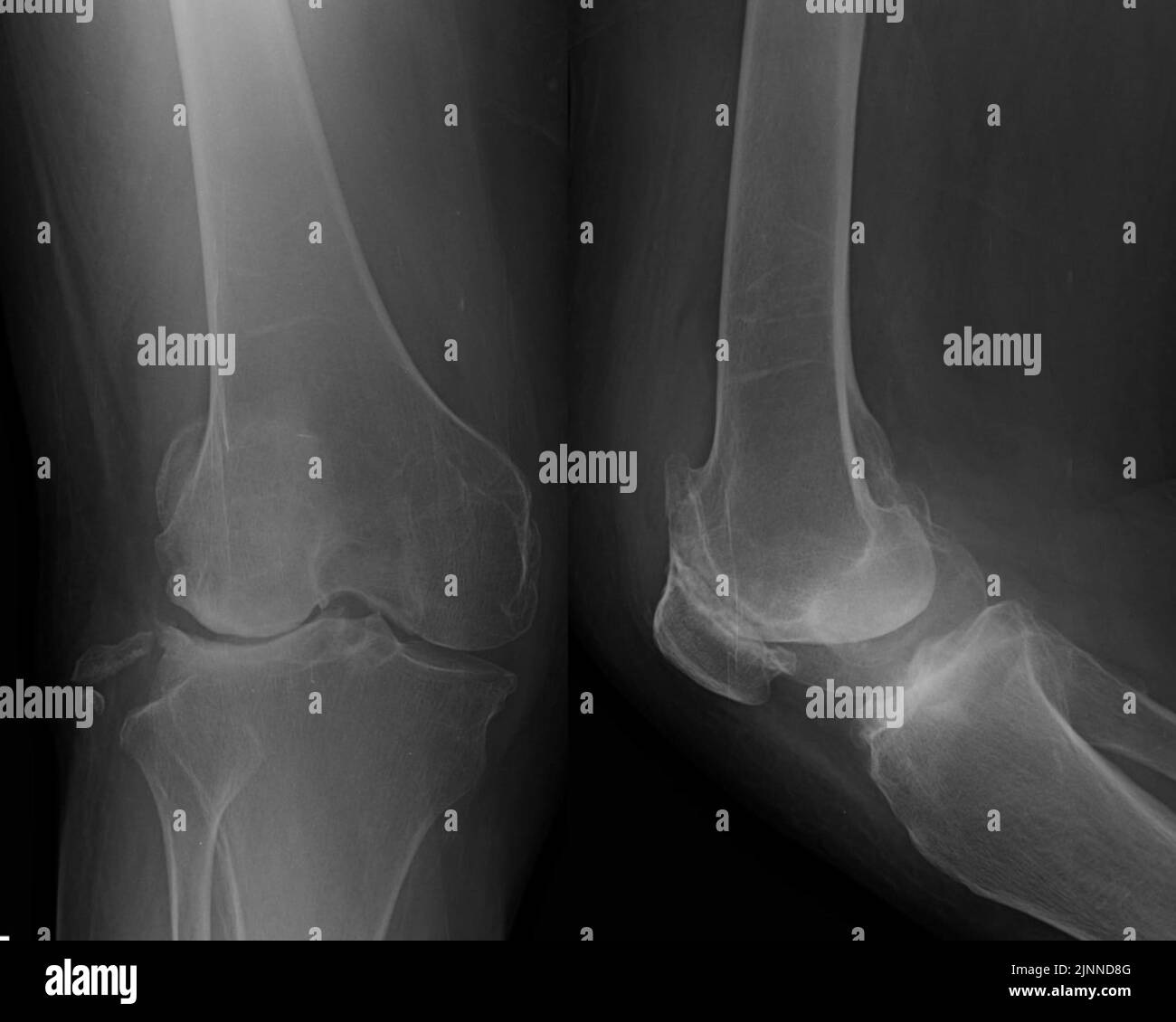 Knee osteoarthritis, X-ray scans Stock Photo