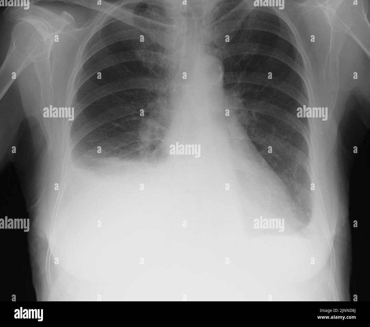 Pleural effusion, Xray Stock Photo Alamy
