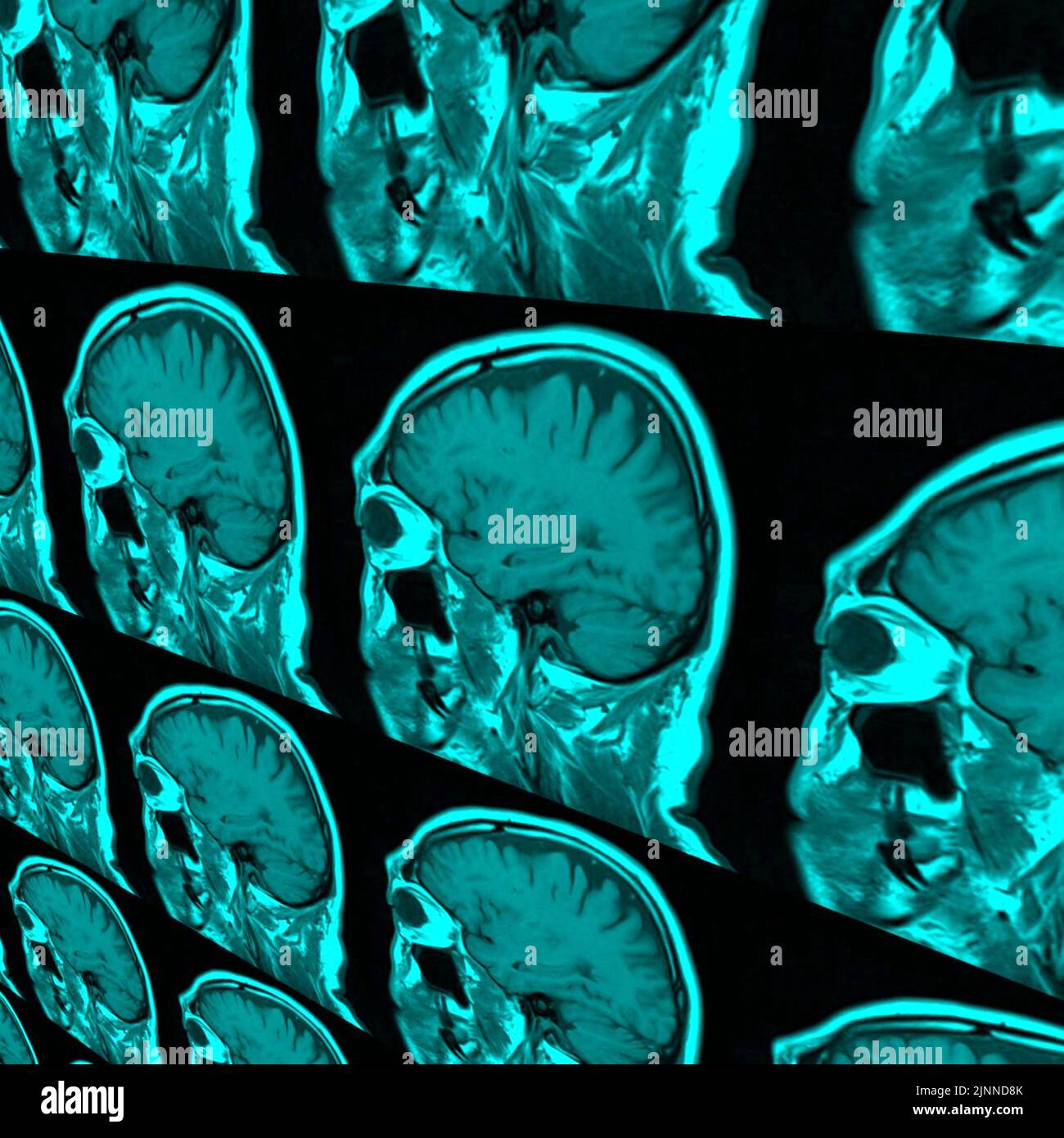 Brain, MRI scan Stock Photo