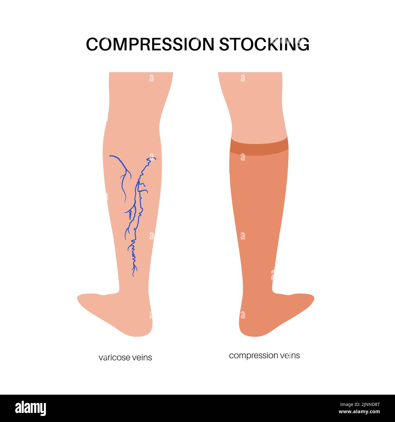 Compression stockings for varicose veins, illustration Stock Photo