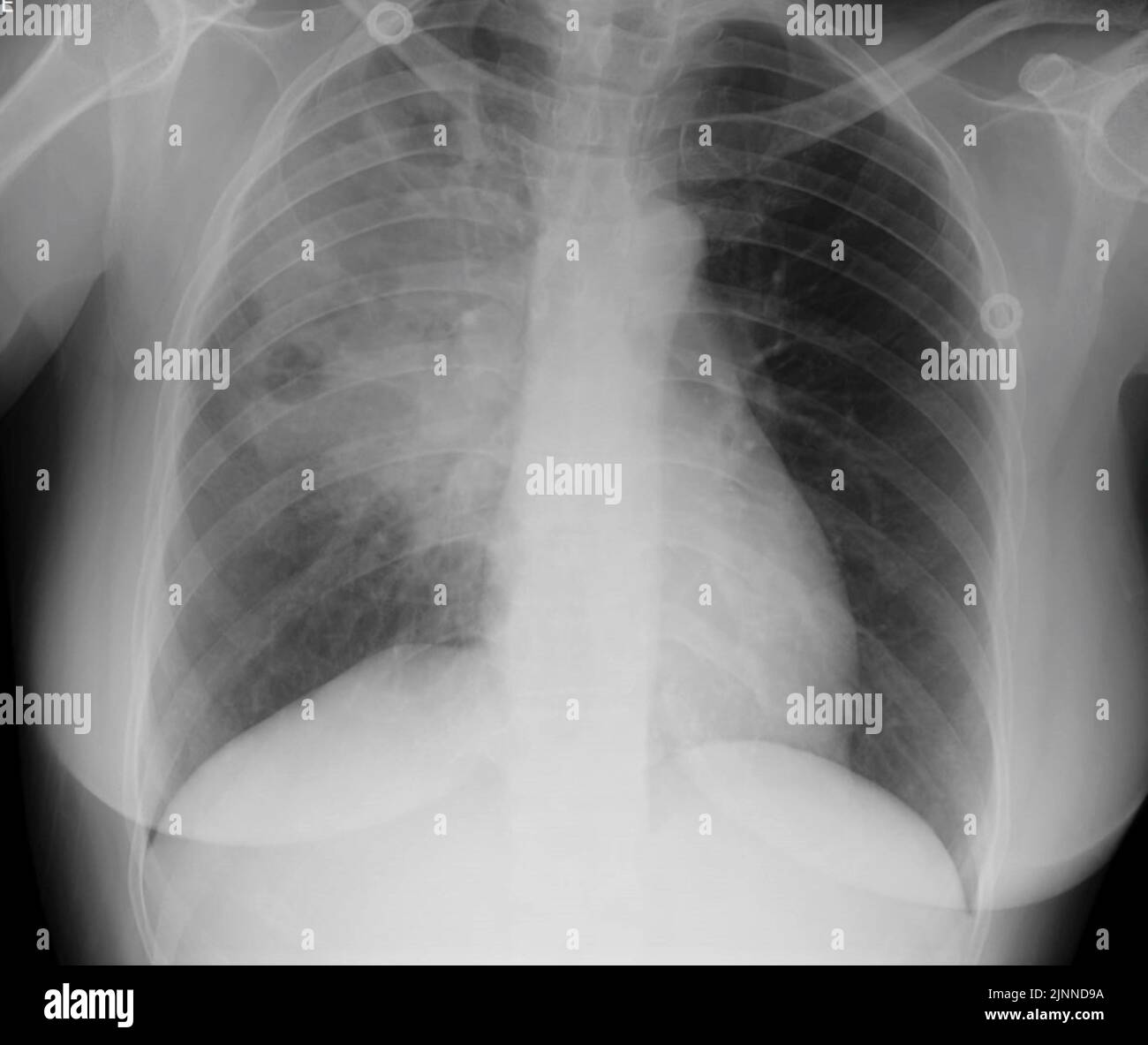 Lung abscess, Xray Stock Photo Alamy