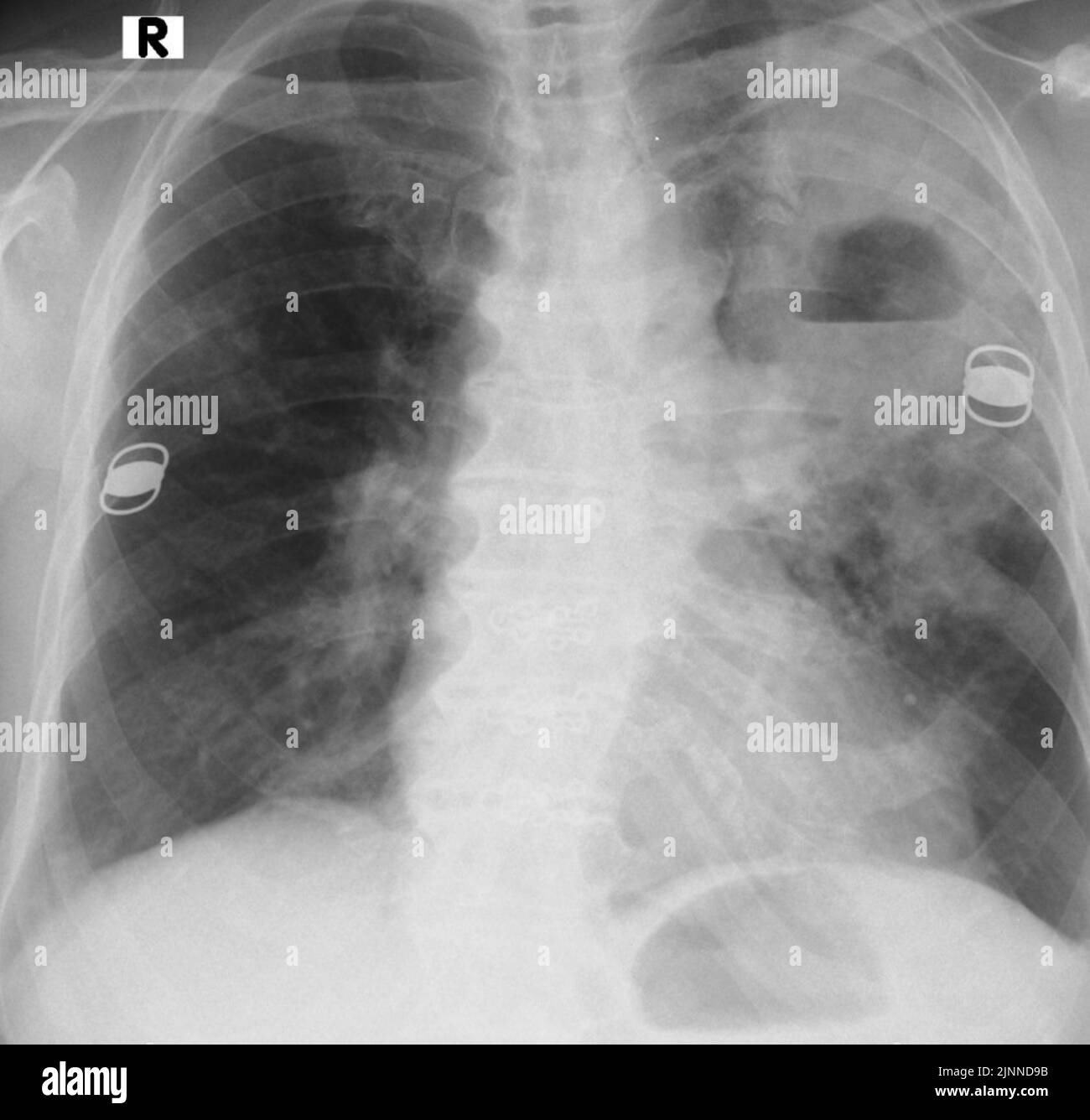 Lung abscess, Xray Stock Photo Alamy
