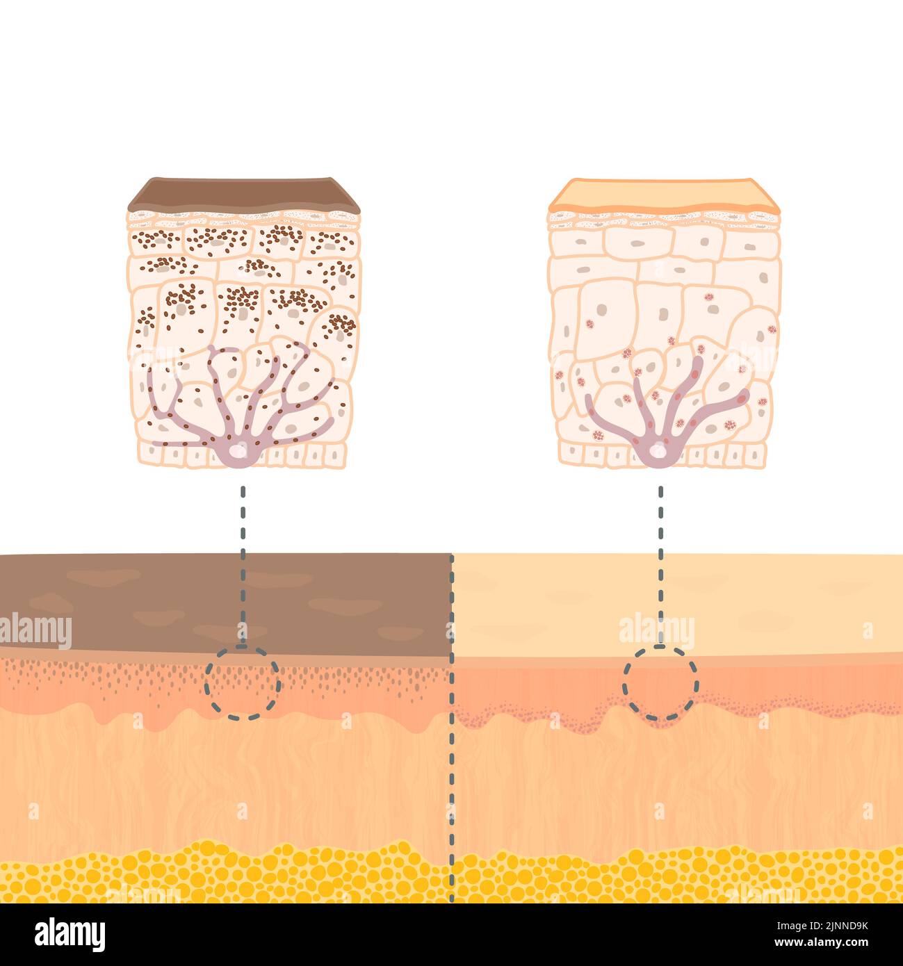 Skin pigmentation, illustration Stock Photo - Alamy