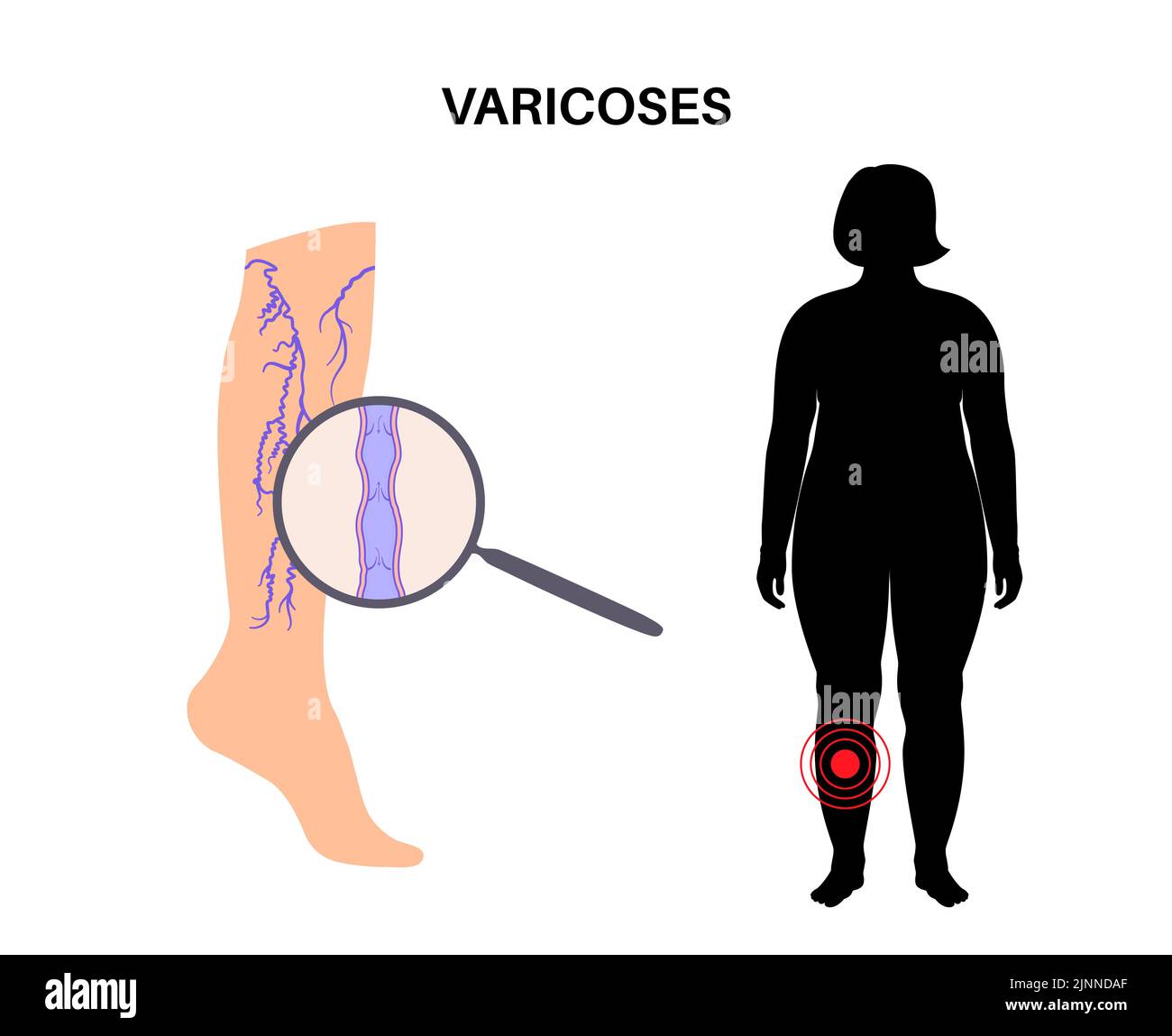 Varicose veins, illustration Stock Photo