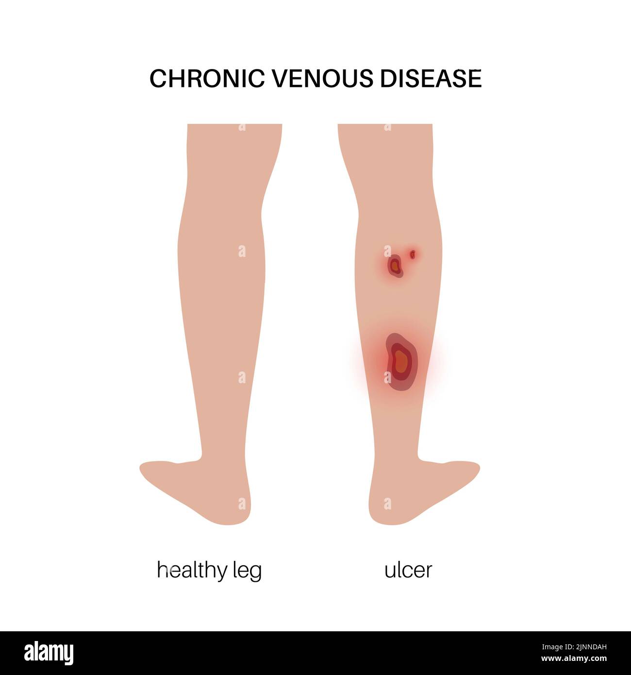 Trophic ulcer, illustration Stock Photo