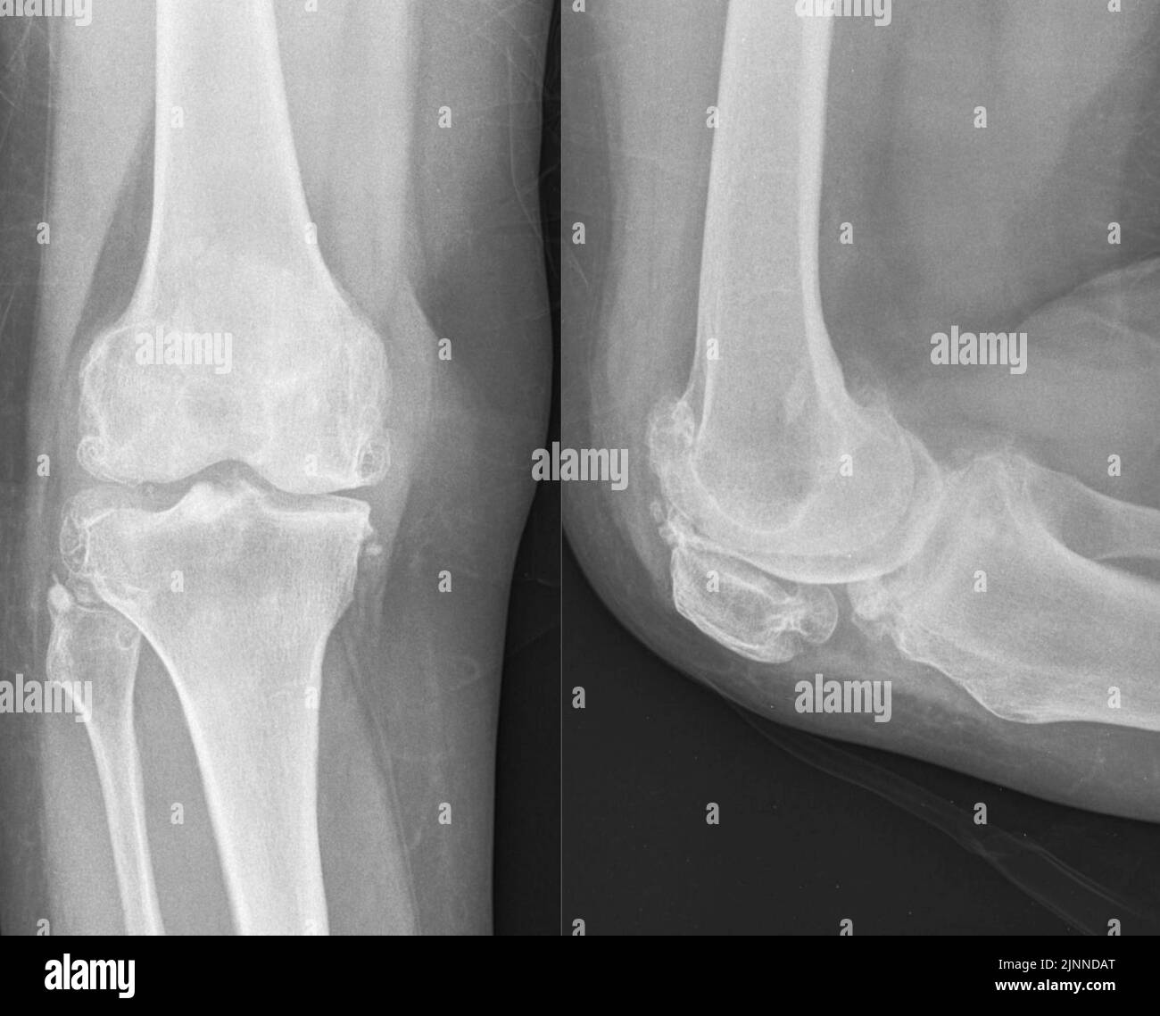 Knee osteoarthritis, X-ray Stock Photo