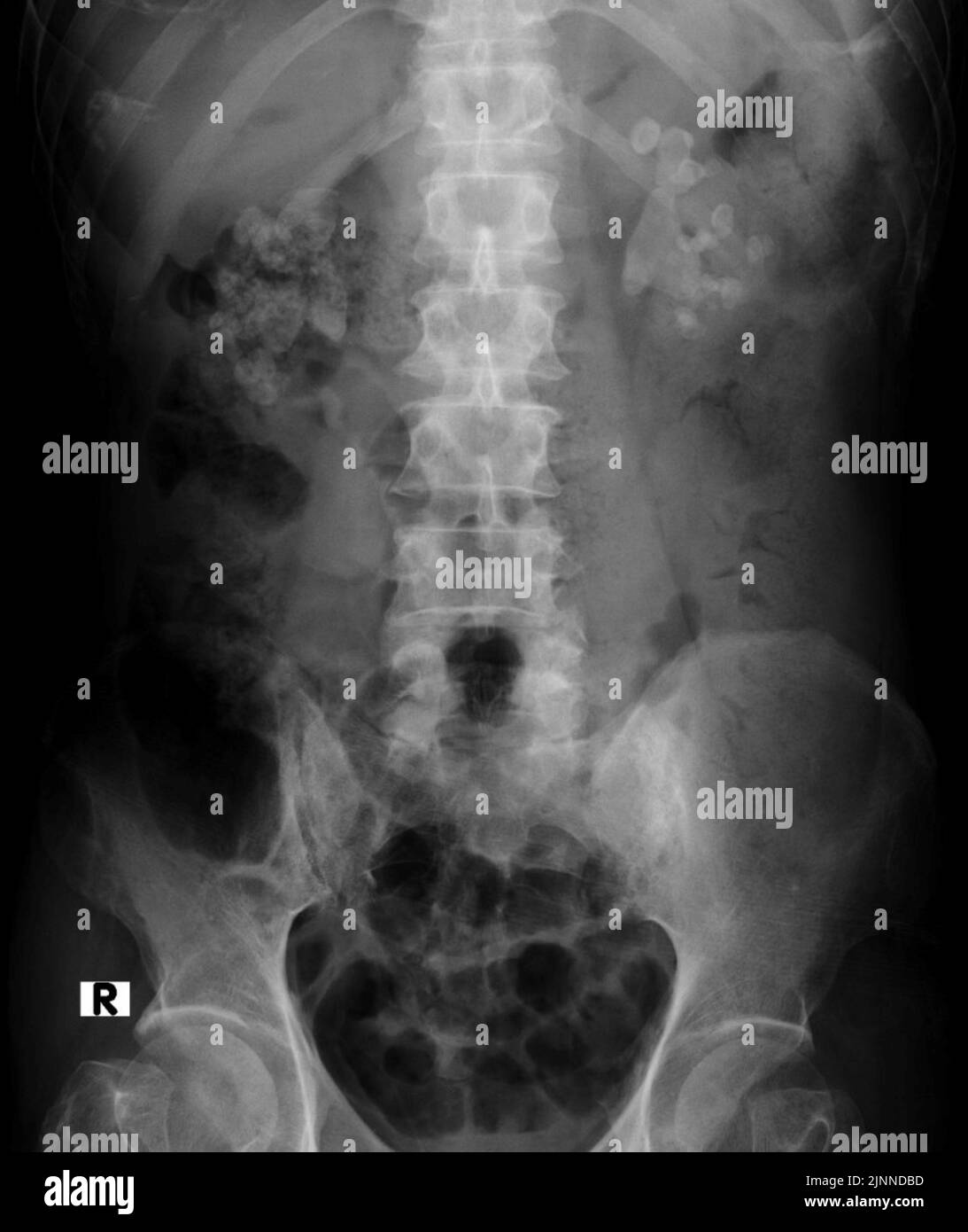 Kidney stones, Xray Stock Photo Alamy