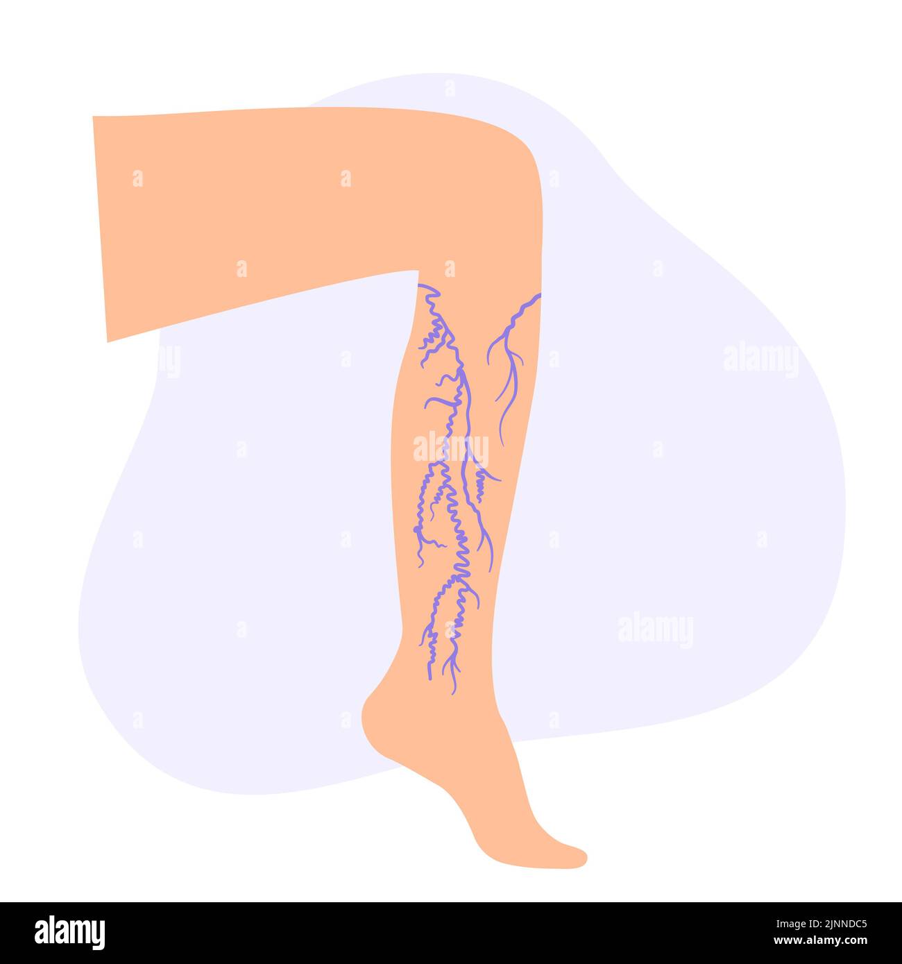Varicose veins, illustration Stock Photo - Alamy