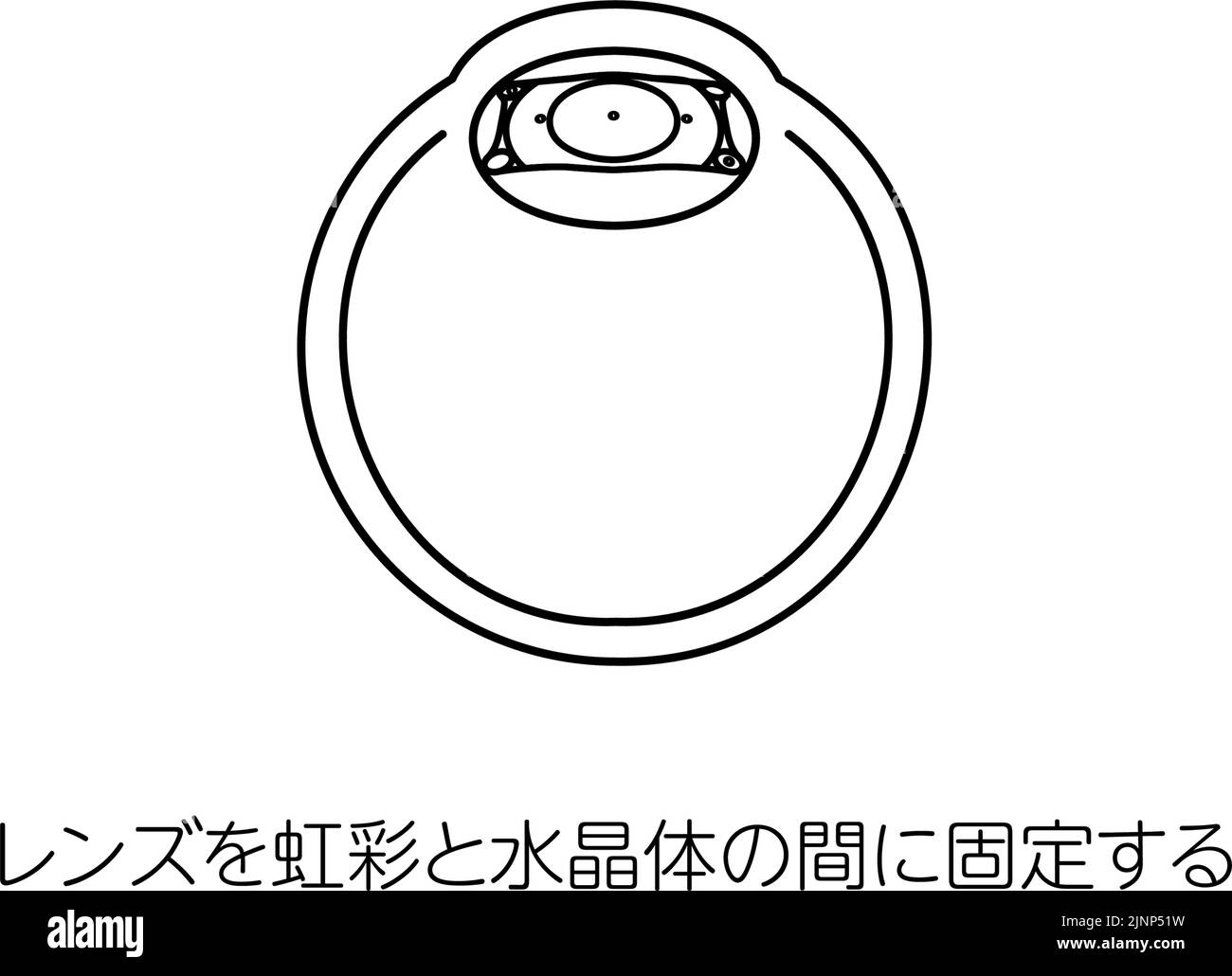 Illustration of ICL (intraocular contact lens) surgery and ICL fixation Translation Fixing