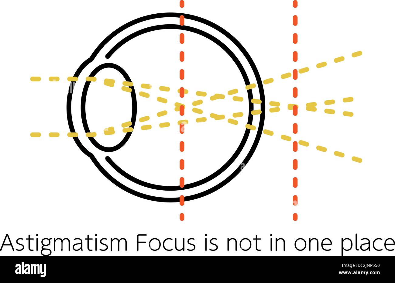 Medical Illustration of Visual Acuity and Refractive Error, Astigmatism