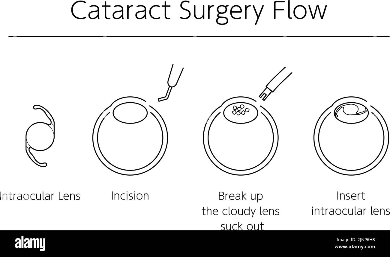 Flow of cataract surgery, illustrated illustration (line drawing) Stock Vector