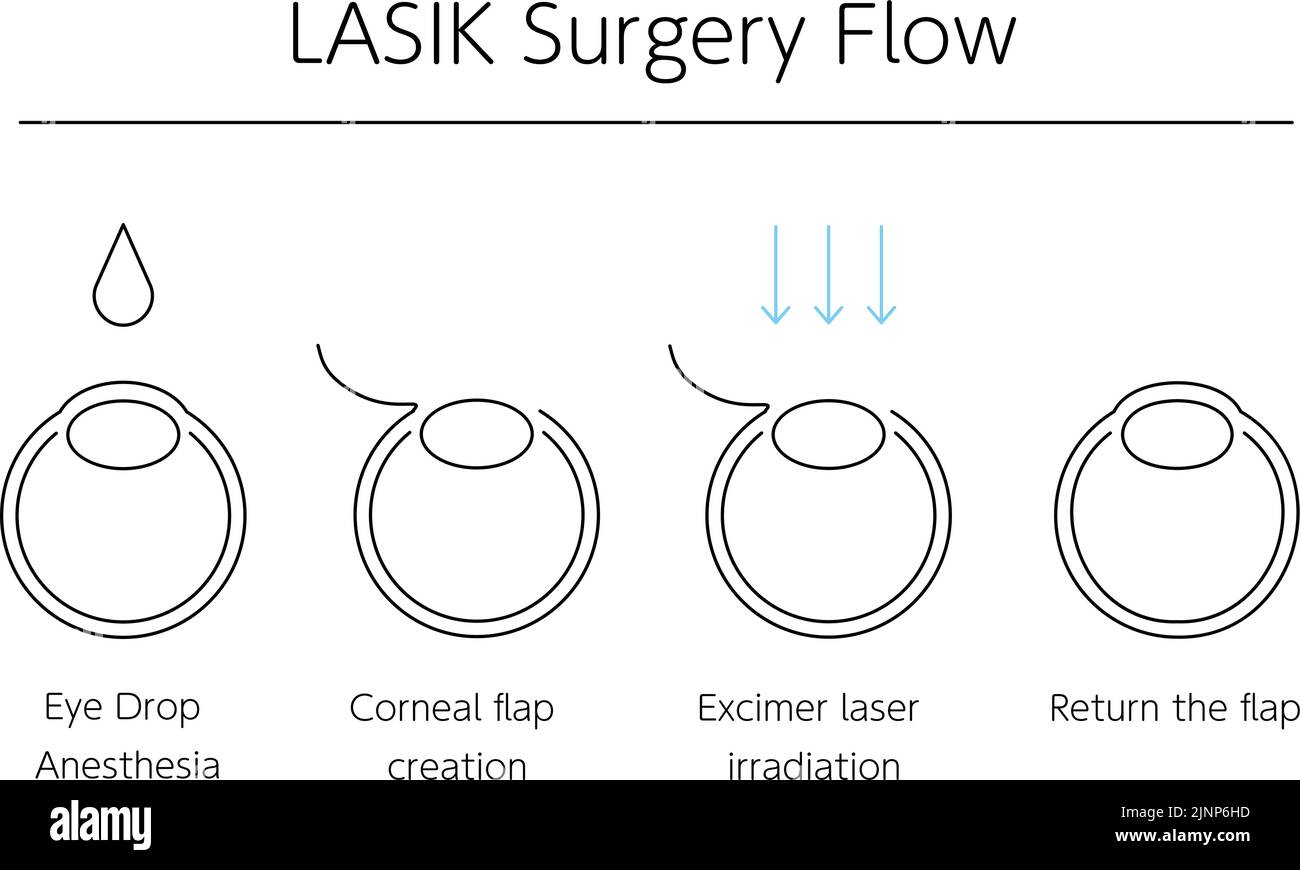Medical illustration of LASIK and refractive surgery Stock Vector