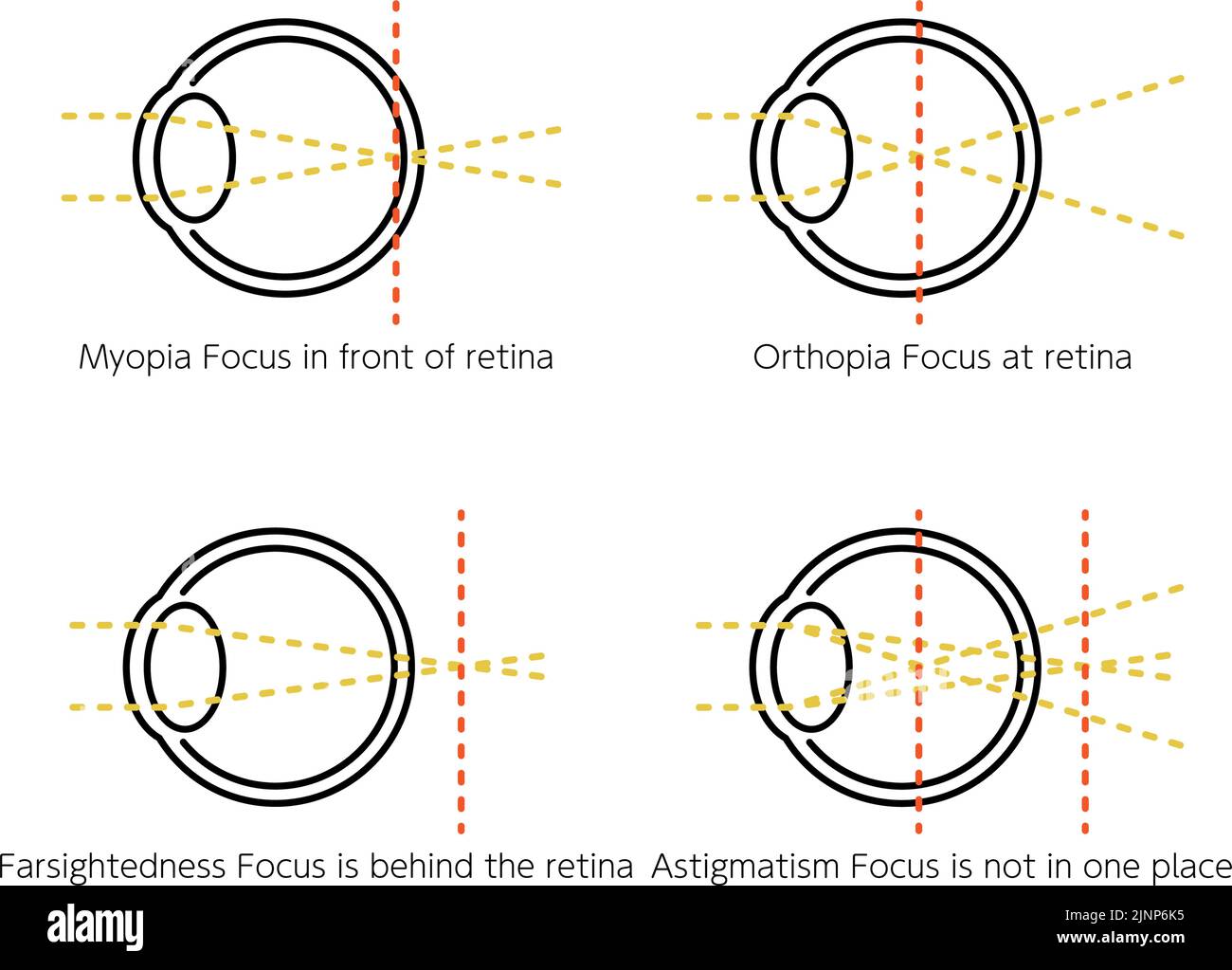 Medical Illustrations of Vision and Refractive Error, Normal, Myopia